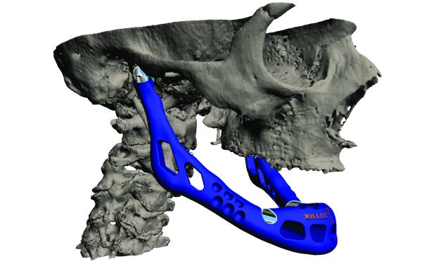 jaw-3d-print Aditivní výroba je velmi často využívána v medicíně. Čelistní implantát vytištěný z titanového prášku pro 83letou pacientku z Belgie se pro své prvenství dostal až do Guinessovy knihy rekordů. Foto: Biomed